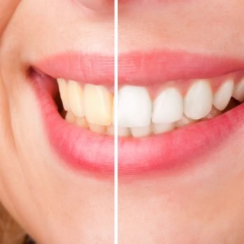 patient after Nashville Cosmetic Dentistry